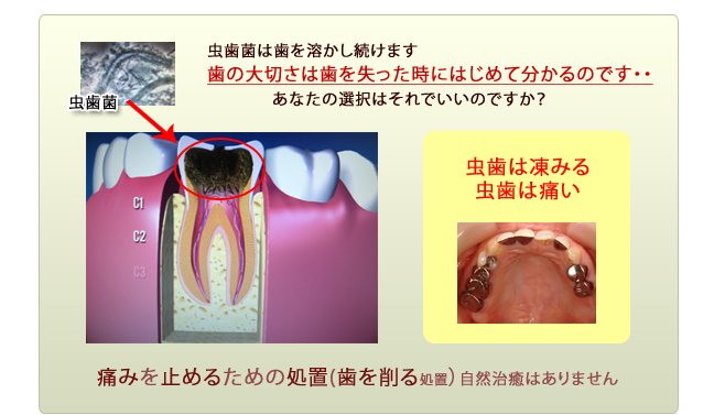 虫歯の進行２