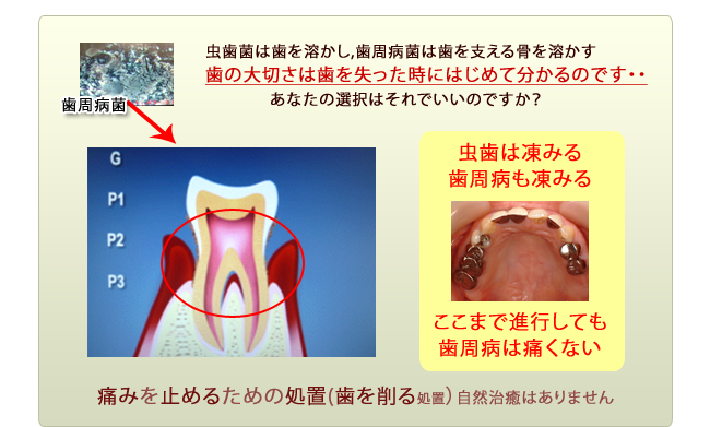 歯周病の進行２