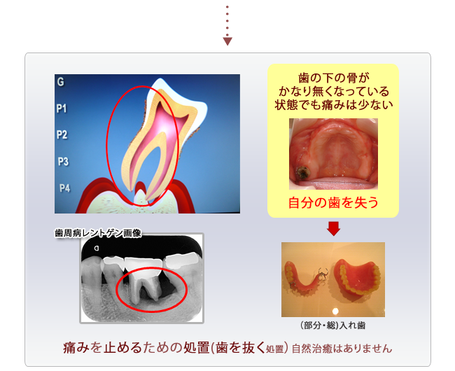 歯周病の進行３