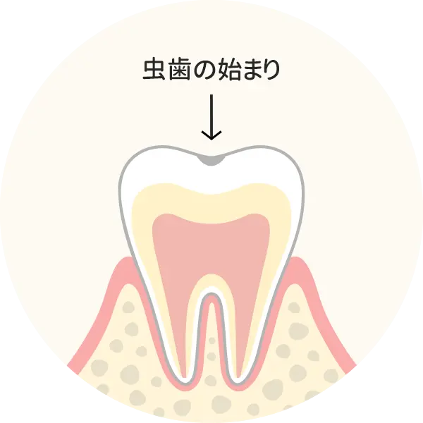 脱灰