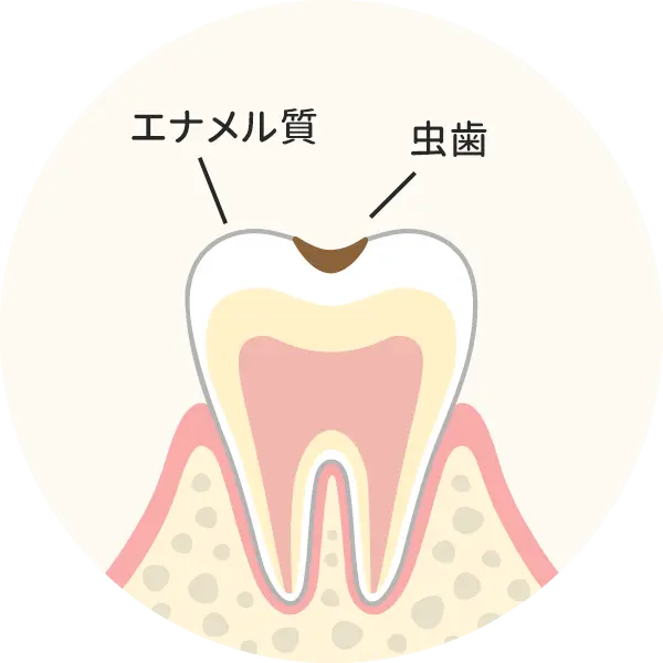 歯の表層（エナメル質）の虫歯