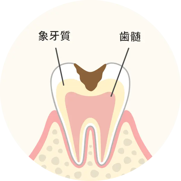 歯の中（象牙質）まで進んだ虫歯