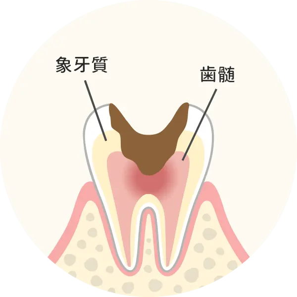 神経まで達した虫歯