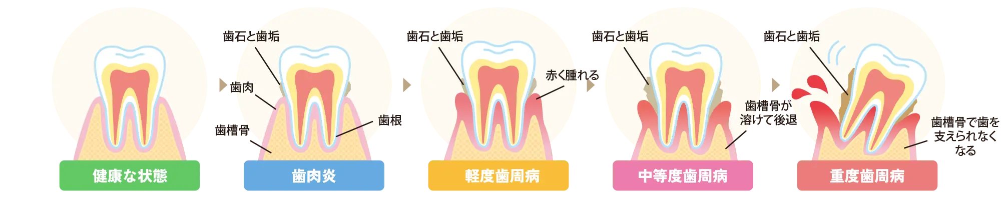 歯周病について