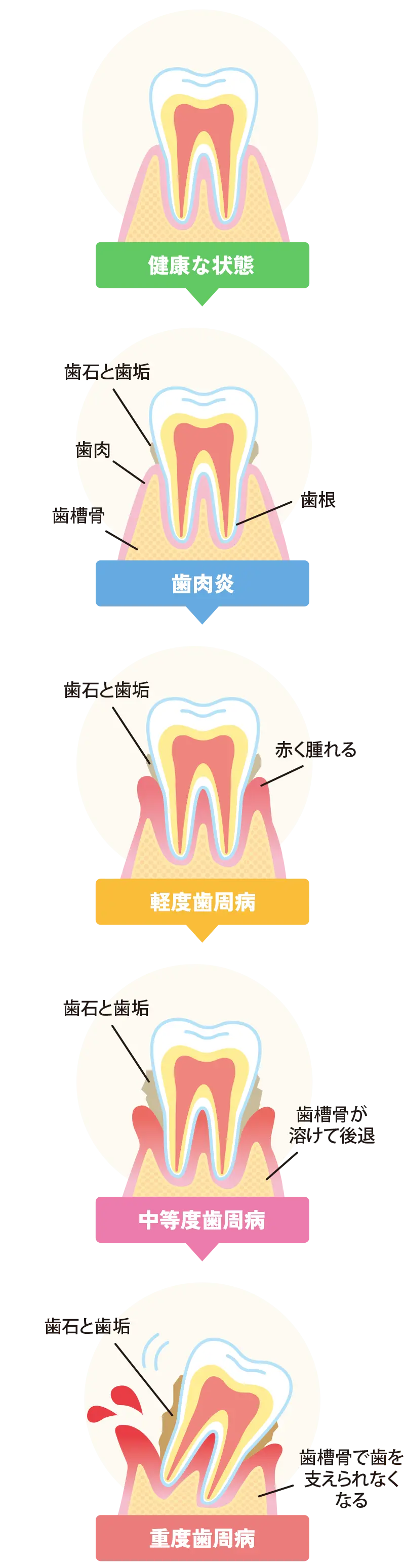 歯周病について