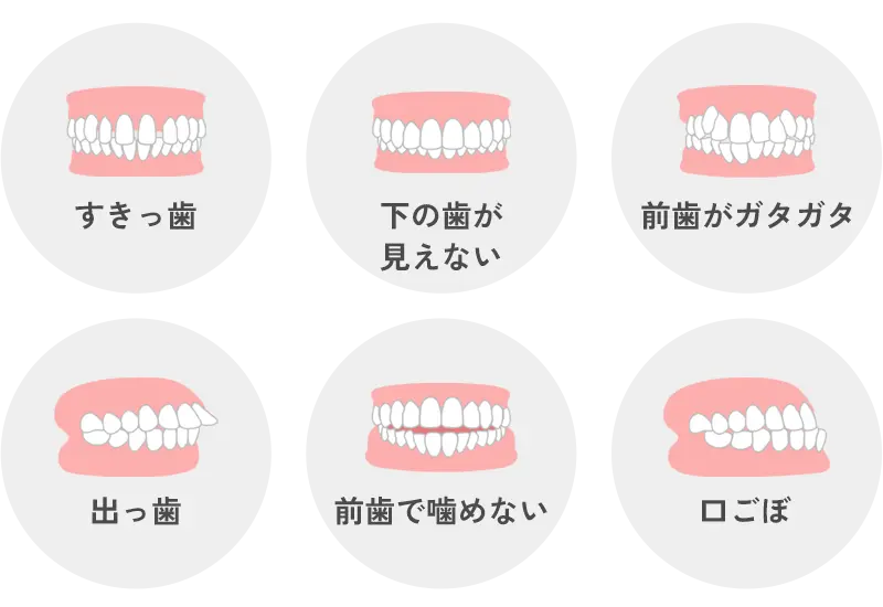 不正咬合
